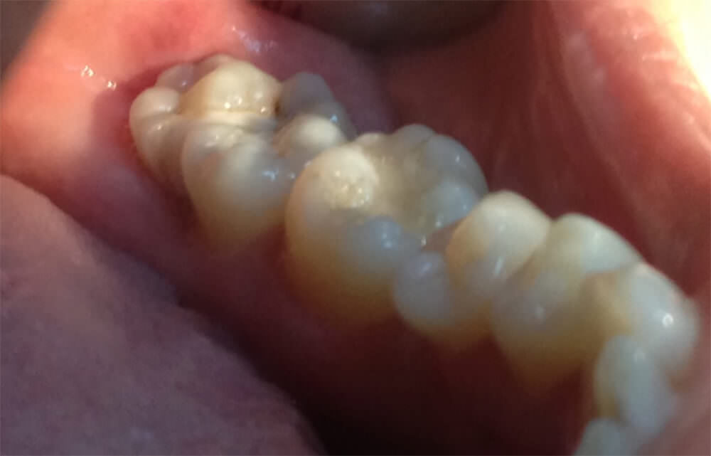 Fig. 1Aspecto Clínico Intrabucal (Fusión de tercer inferior y cuarto molar supernumerario)
Fig. Appearance clinical intraoral (Fusion of third bottom and fourth molar supernumerary) Fuente: Caso clínico