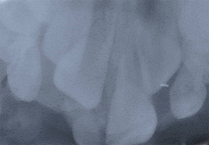 Imagen 5: Radiografía intraoral oclusal