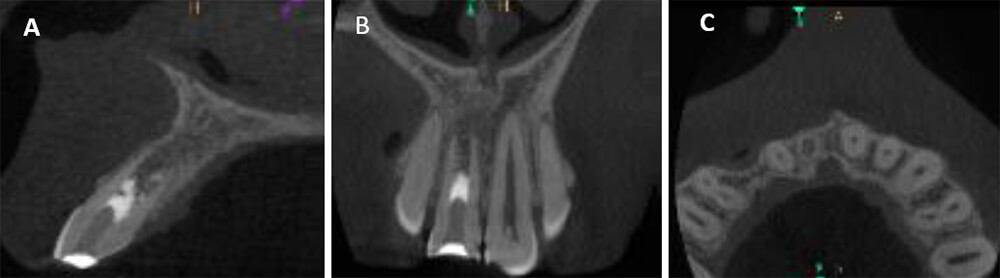 Figura 4. Las imágenes de la THC a los 24 meses (febrero 2015) con un corte de orientación oblicua. Se muestran los 3 planos: sagital (A), coronal (B) y axial (C). Se esclarece la formación de un tejido de aspecto óseo en el interior del conducto.